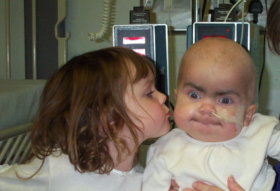 Amy and Sophie aged 3 and 1 respectively in a hospital room. Both children are wearing white t-shirts, Amy has short brown hair and Sophie does not have hair. Sophie has an NG tube in her nose. Amy is turned towards Sophie giving her a kiss.